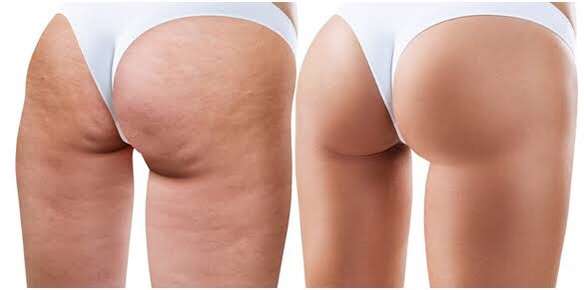 Cellulite Treatment